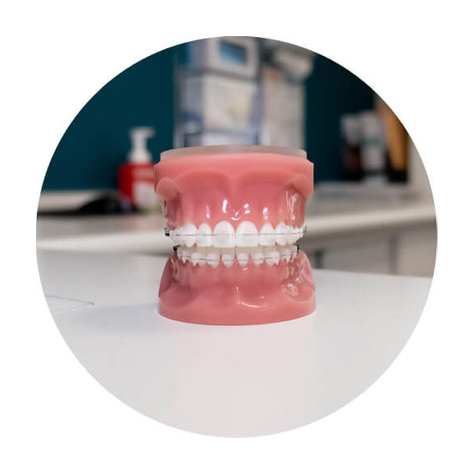 Standard metal braces