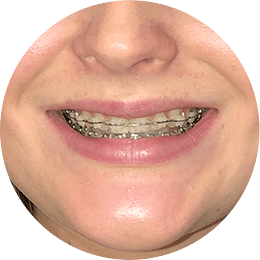 Metal Braces