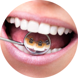 Lingual Braces