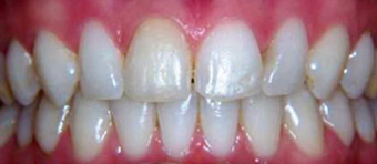 before & after