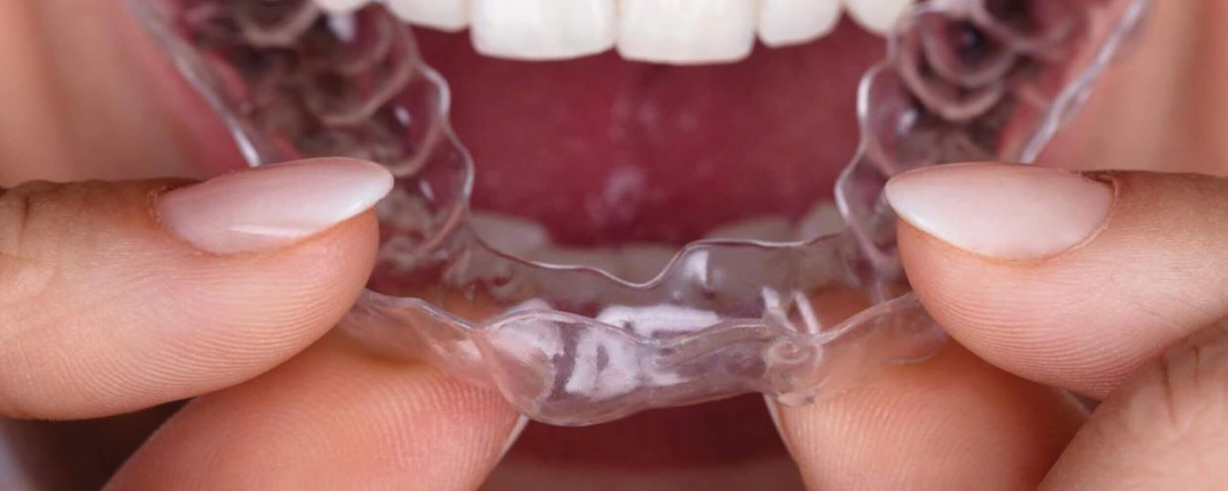 Straighten your teeth with invisible braces