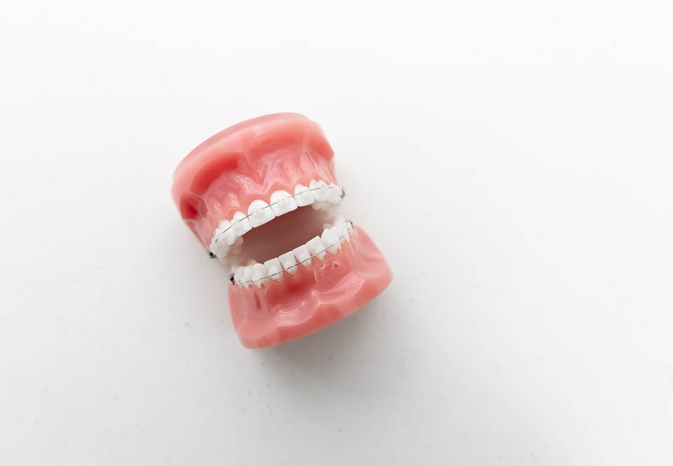 ceramic braces