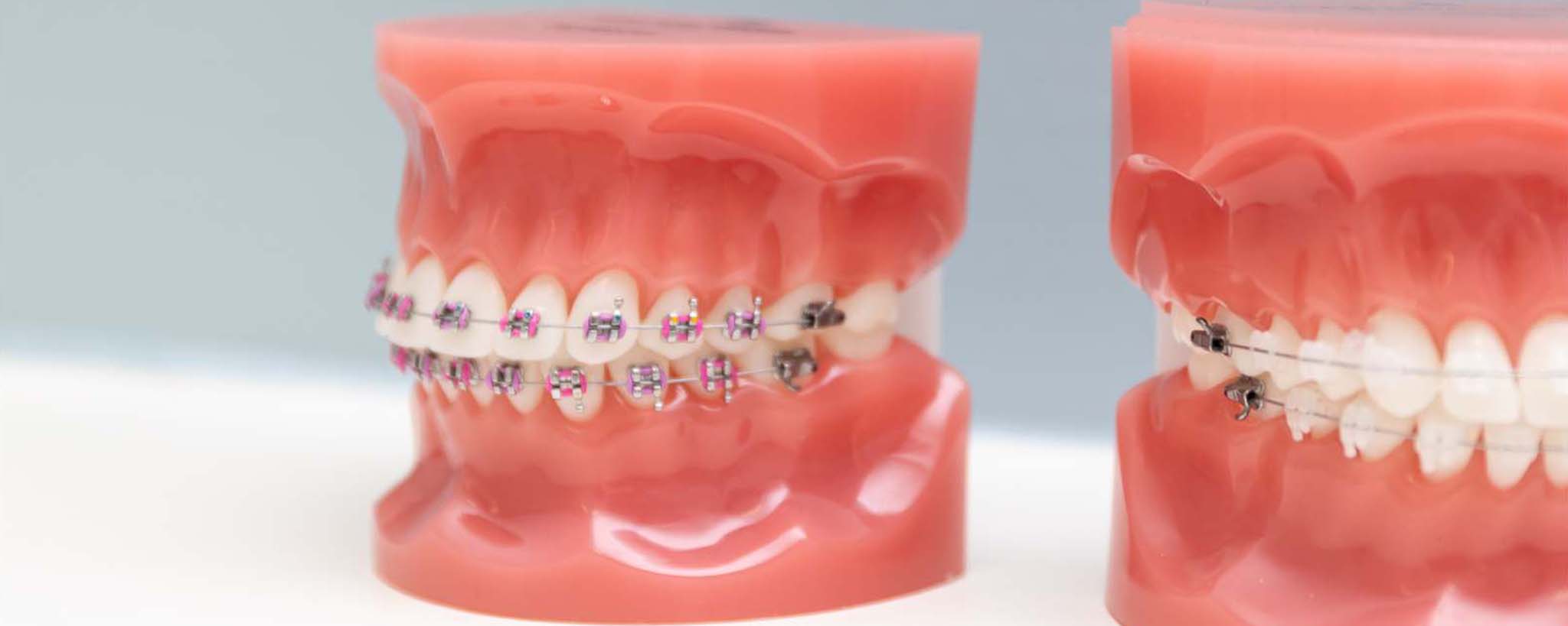 How Do I Know If I Need Braces? « Smile Team Orthodontics | Blog