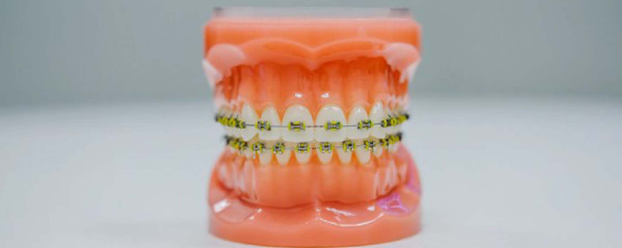 What Do I Do If My Teeth Shift After Braces?