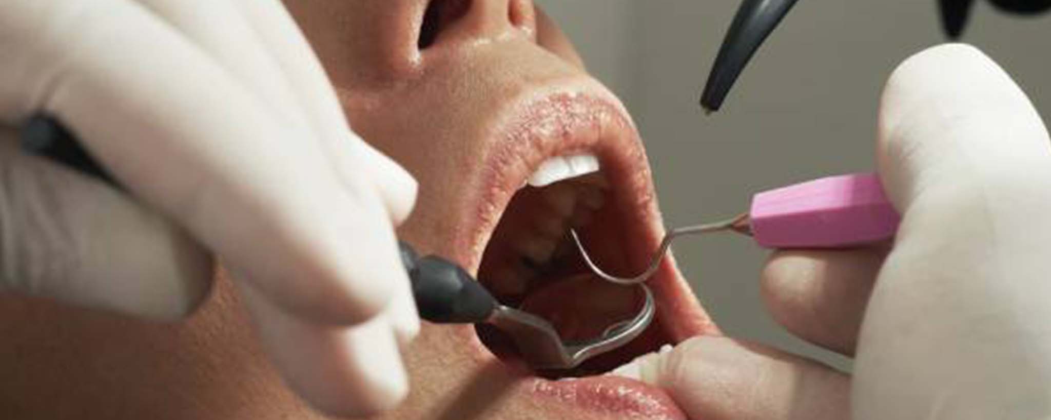 If & When Wisdom Teeth Need Extracting