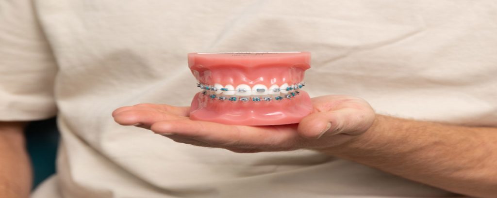 Foods You Can and Can’t Eat with Braces « Smile Team Orthodontics | Blog