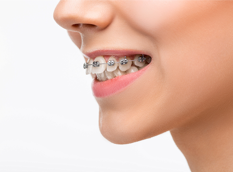 What is an overbite and what is an overjet? What is the difference?