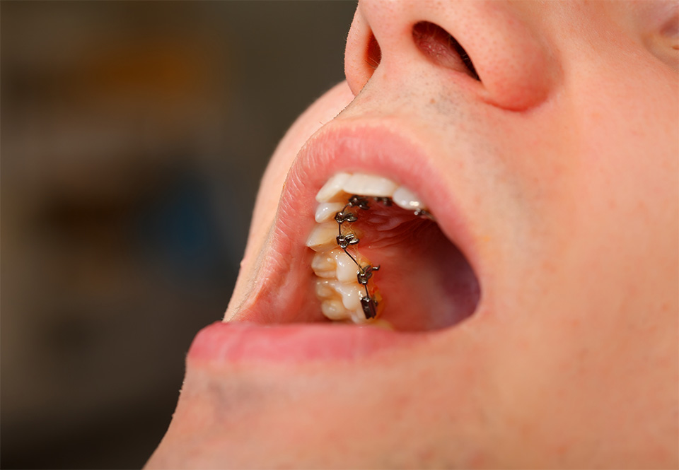 Lingual braces — Stock Photo, Image