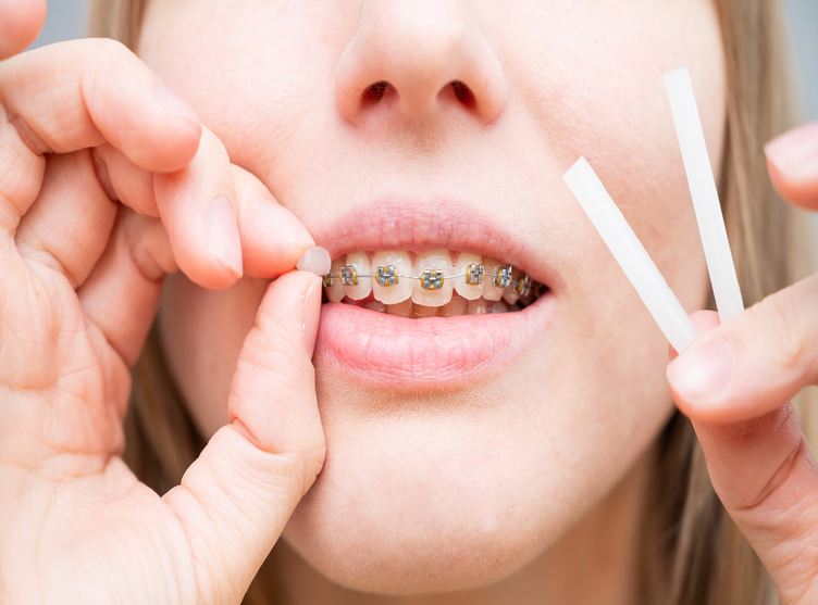 Close-up portrait of a young woman applying orthodontic anti-scratch wax to the braces — Stock Photo, Image