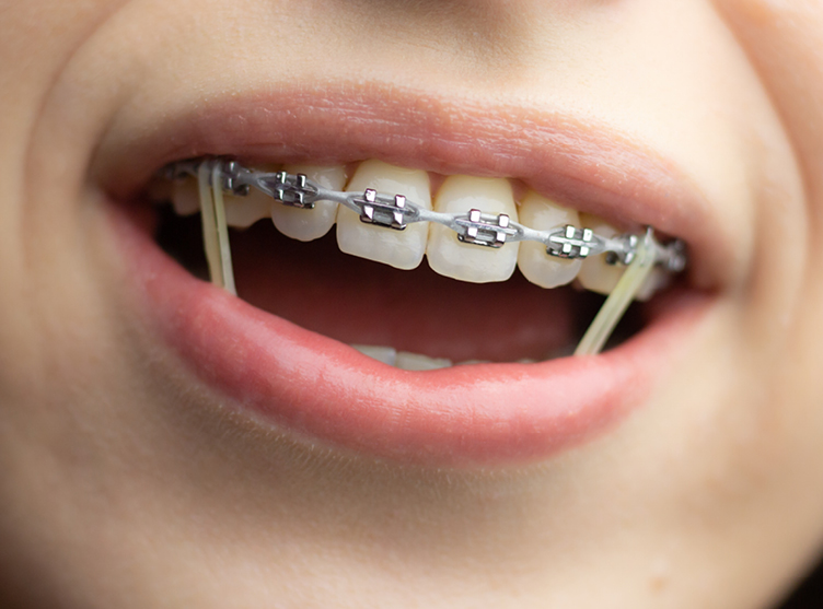 Braces Elastics (Rubber Bands) for Bite Correction and Alignment